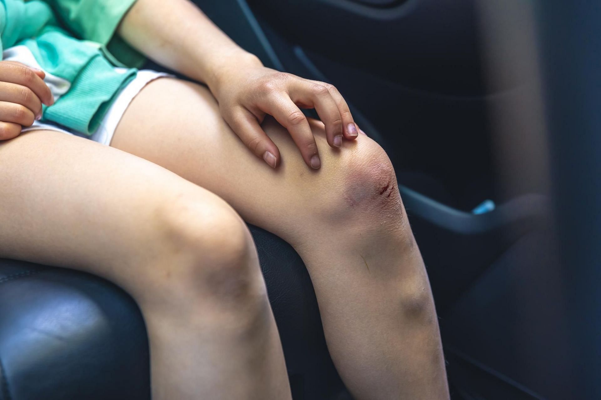 Home remedies for bruises (Image via Freepik)